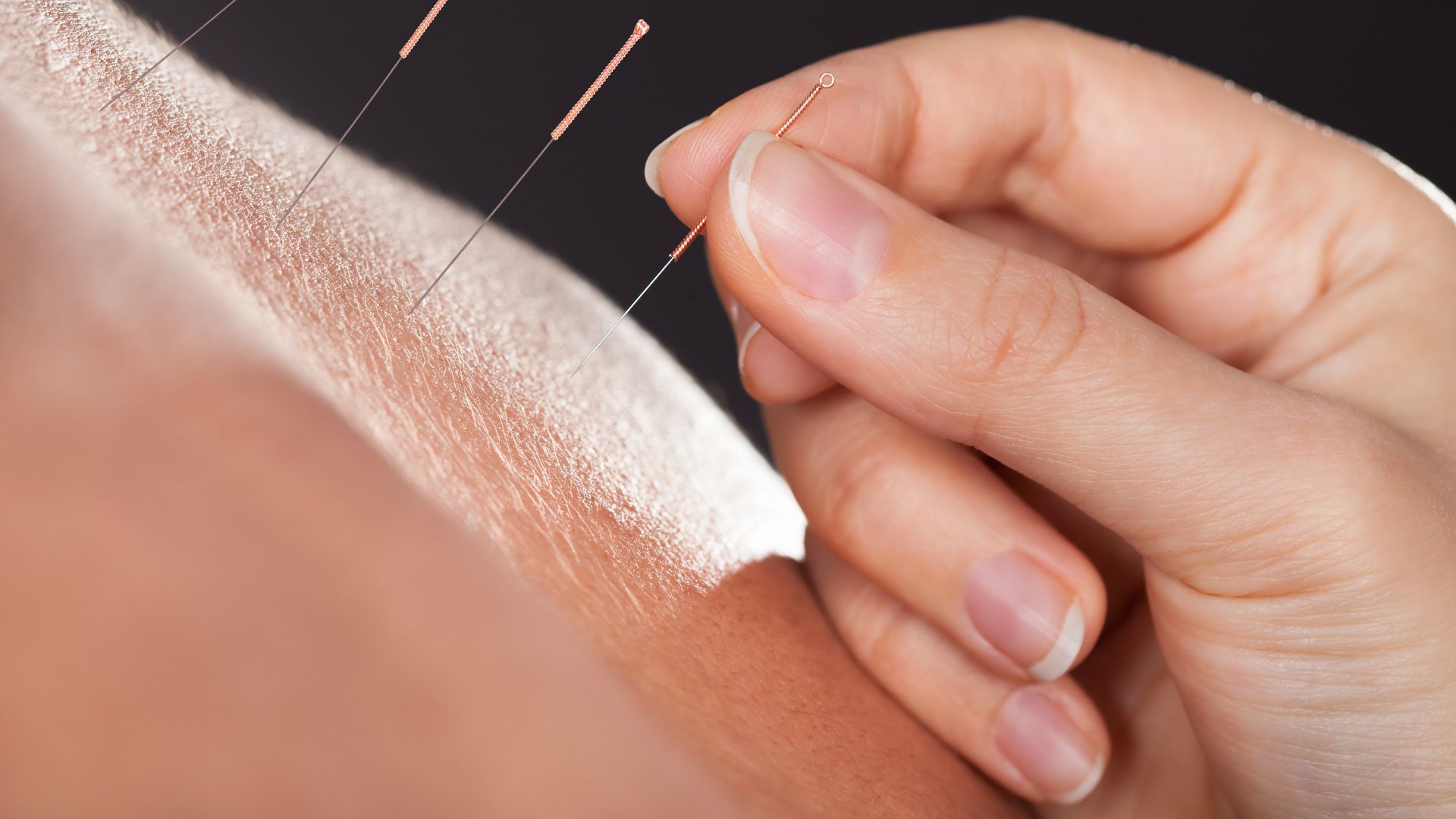 Acupuncture needles being inserted into skin during traditional treatment