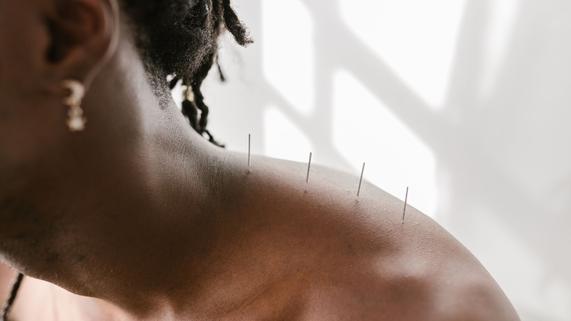 Acupuncture needles inserted into shoulder with soft window light