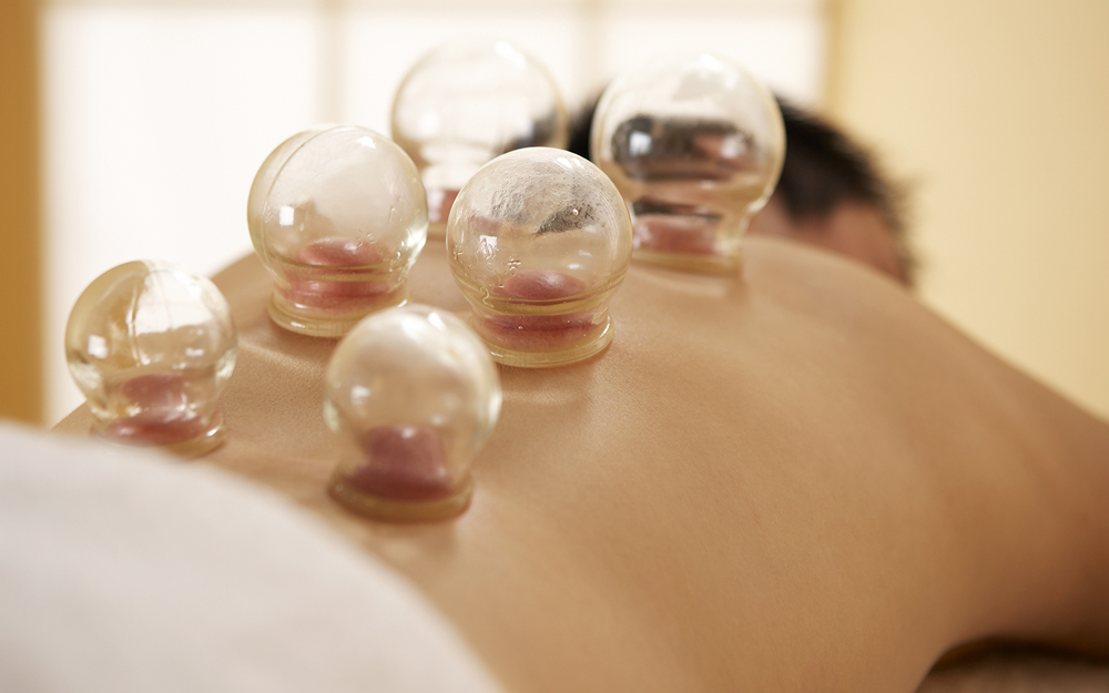 Cupping therapy with glass cups placed on person's back for alternative treatment